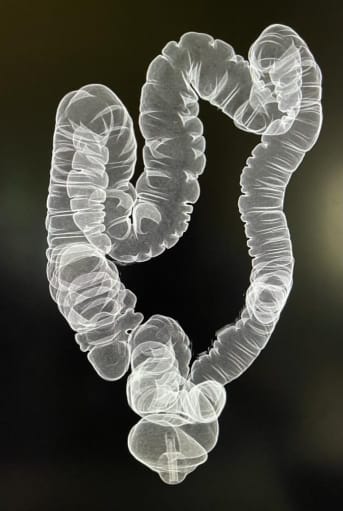 Photo of colon screened for cancer